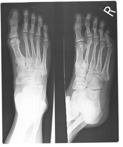 Foot X-Ray by Eric Schmuttenmaer